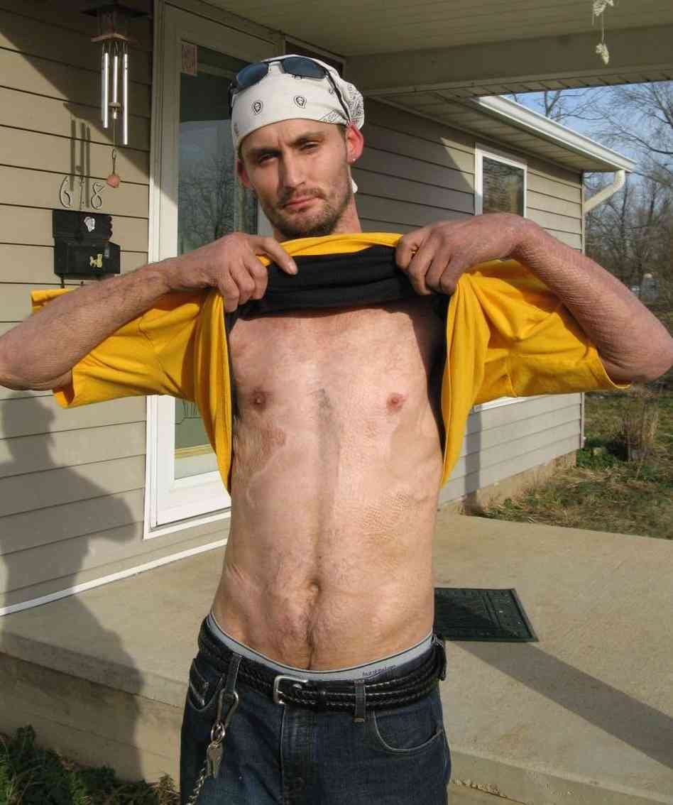 Meth Epidemic Burns