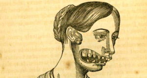 Woman With Phossy Jaw Sketch