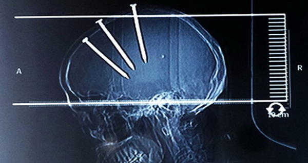 Weirdest X Rays Skulls Nails