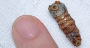 Botfly Finger