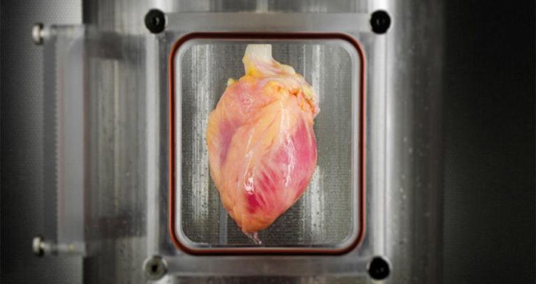Human Heart Transplant