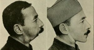 Man Missing Jaw Comparison