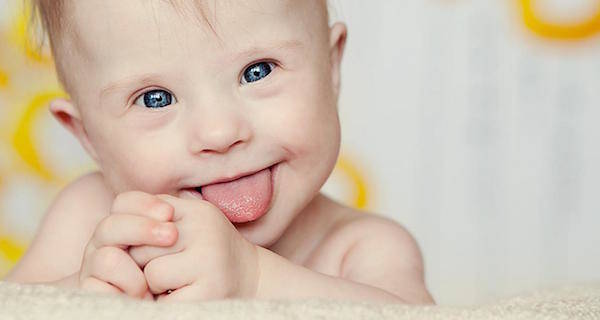 Down Syndrome Baby