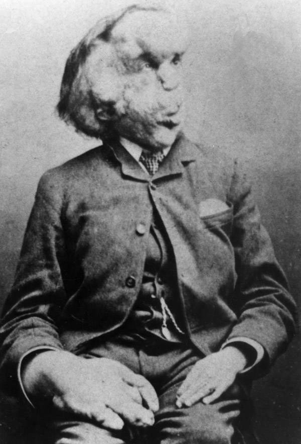 Elephant Man
