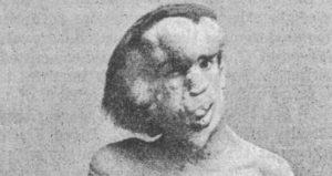 Joseph Merrick Elephant Face