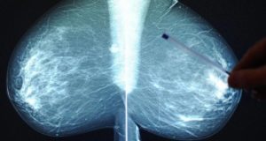 Breast Cancer X Ray