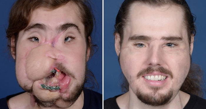 Cameron Underwood Face Transplant