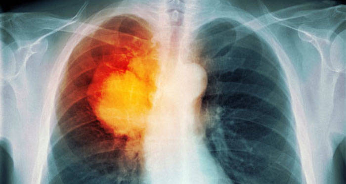 Cancer Isolated In X Ray