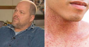 Emmanuel Bilodeau Measles Rash