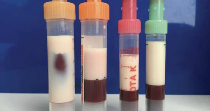 Vials Of Thick Milky Blood Featured