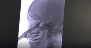 Knife Face Xray Featured