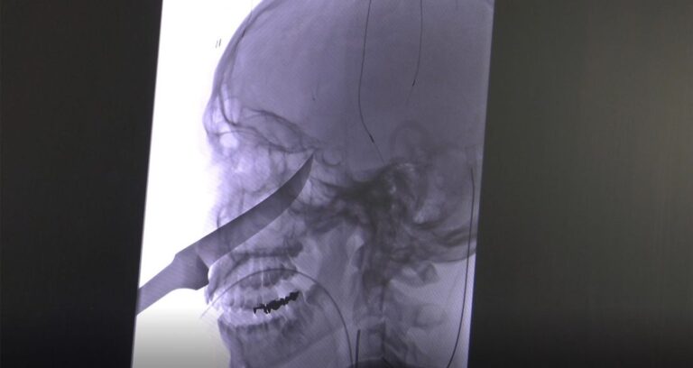 Knife Face Xray Featured