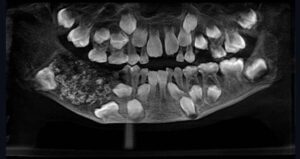 Indian Boy Teeth Xray