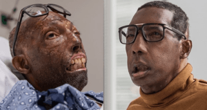 First African American Face Transplant