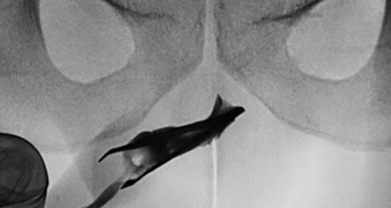 Tweezers In Urethra Featured