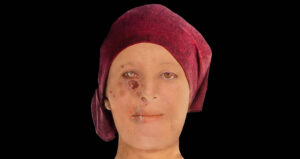 Scottish Leprosy Victim