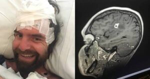 Tyson Bottenus Brain Fungus