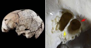 Earliest Ear Surgery Skull And Close Up