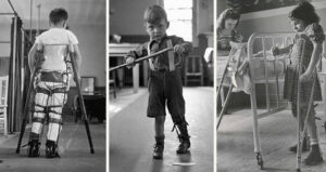 Three Views Polio Victims